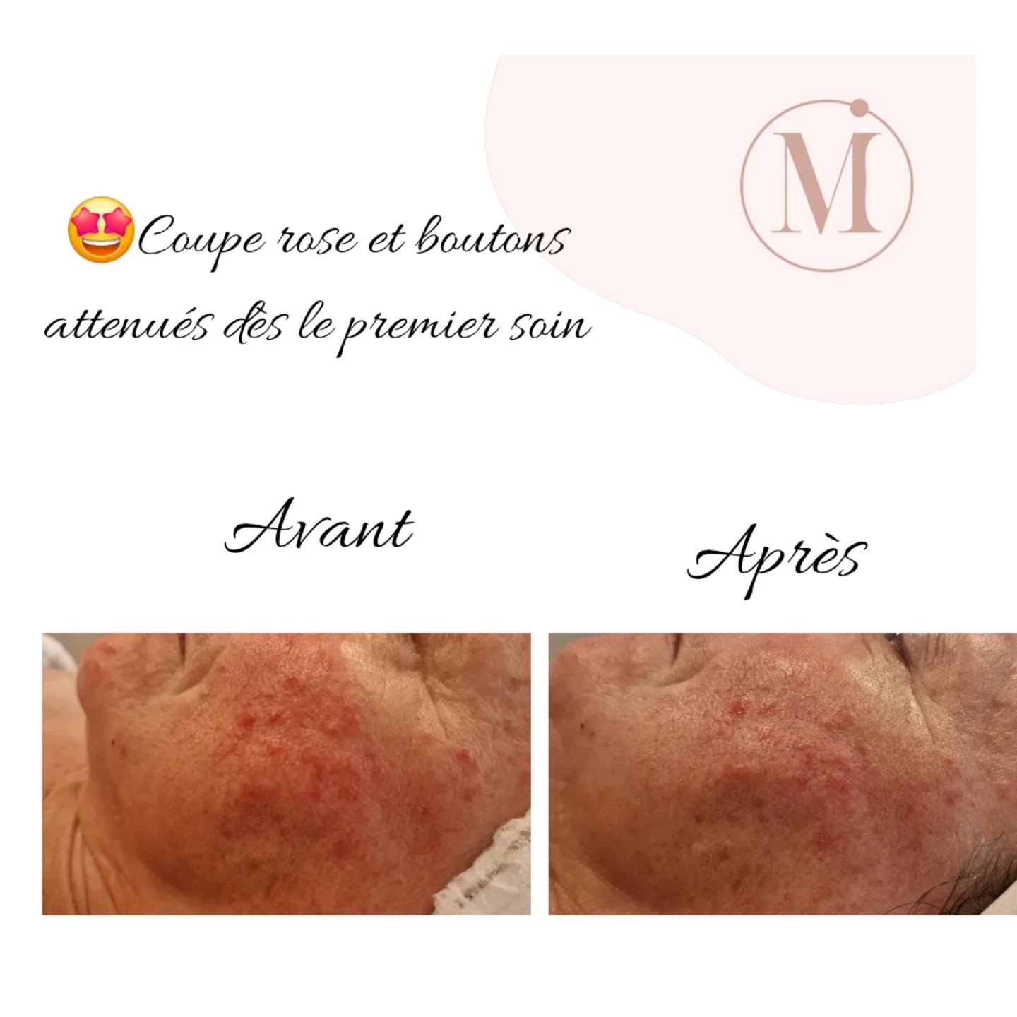 Résultat avant/après soin visage - Amélioration de la texture de la peau