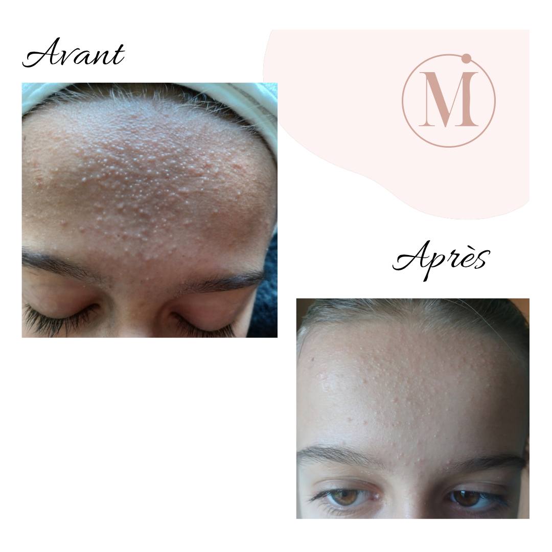 Résultat avant/après soin uniformisant - Teint éclatant et unifié